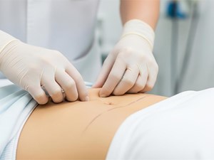 5 zonas comunes donde eliminar grasa localizada de forma eficaz con la liposucción