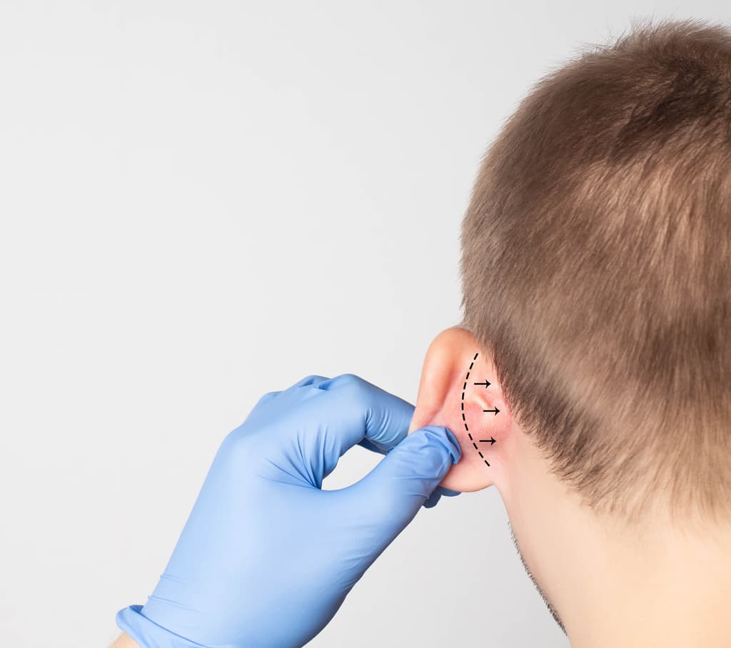 Ventajas de la operación de orejas