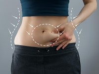 Tipos de abdominoplastia que realizamos en la Clínica Dr. J. L. Vila Moriente